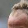 Leigh Griffiths' Hairline